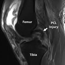 What is PCL?